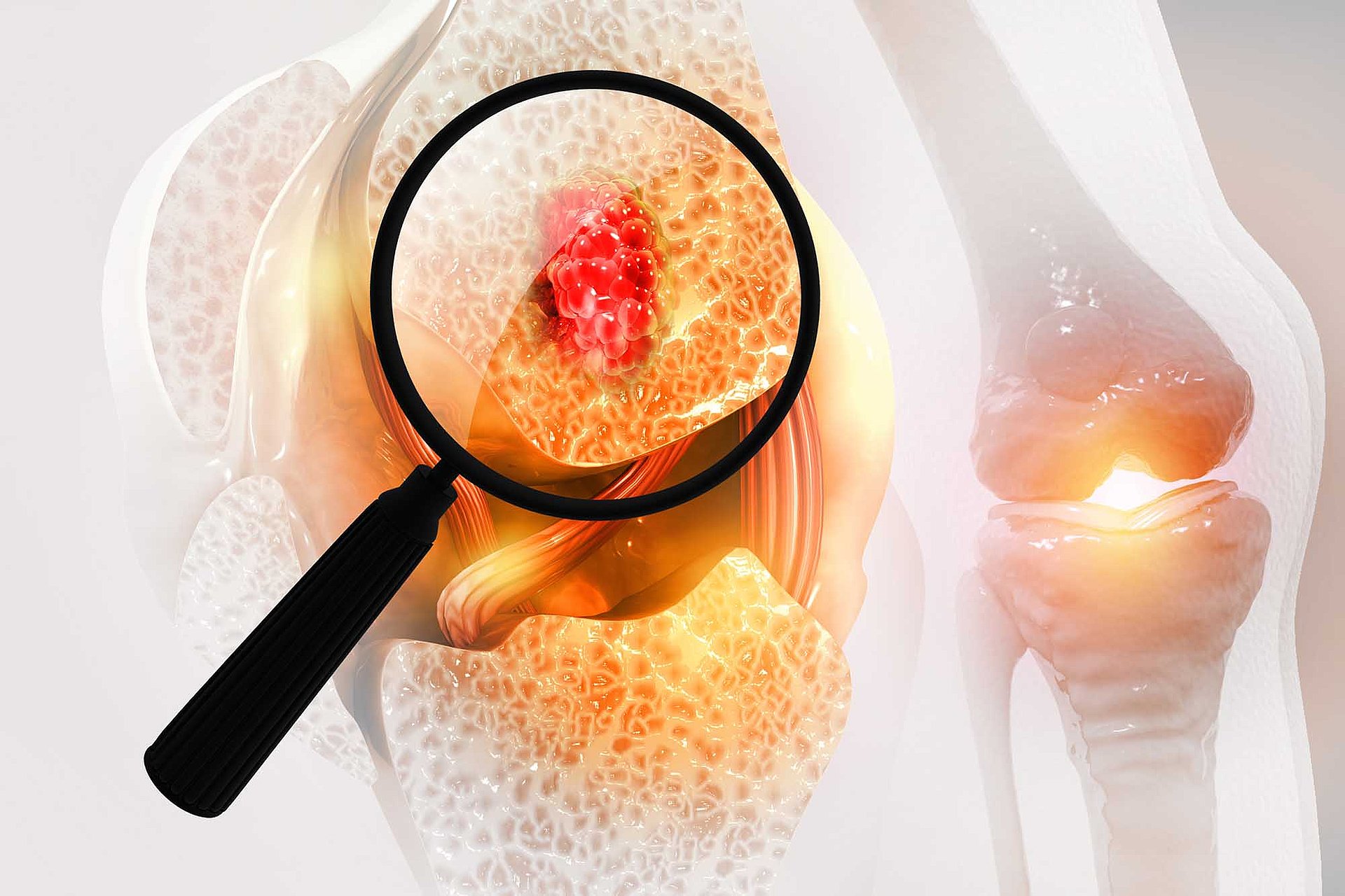 Rohrhof-Apotheke | Osteoporose Es handelt sich um eine graphische Gestaltung eines Kniegelenks, mit Blick nach "Innen". Eine Lupe vergrößert den Knochenaufbau und zeigt in diesem Fall große offene Poren. Das Bild handelt von Osteoporose.