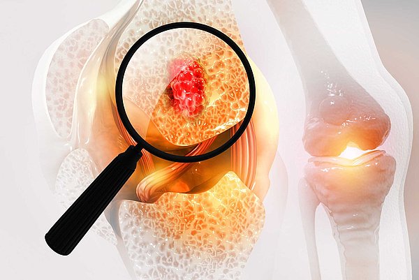 Rohrhof-Apotheke | Osteoporose Es handelt sich um eine graphische Gestaltung eines Kniegelenks, mit Blick nach "Innen". Eine Lupe vergrößert den Knochenaufbau und zeigt in diesem Fall große offene Poren. Das Bild handelt von Osteoporose.